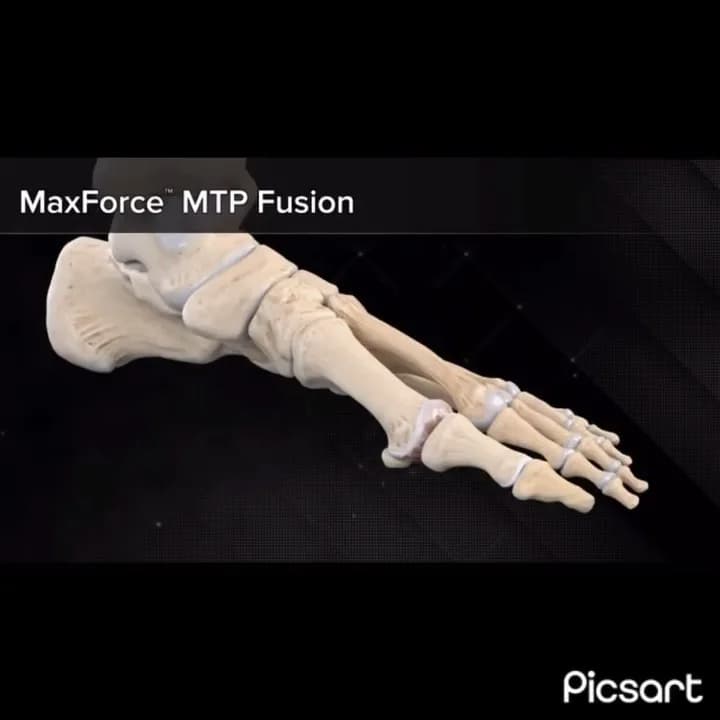 ست فیوژن MTP ارتوپدی