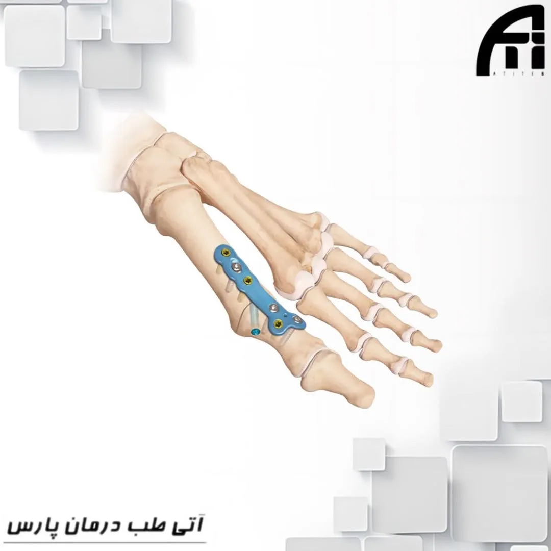 ست فیوژن MTP ارتوپدی — عکس ۲