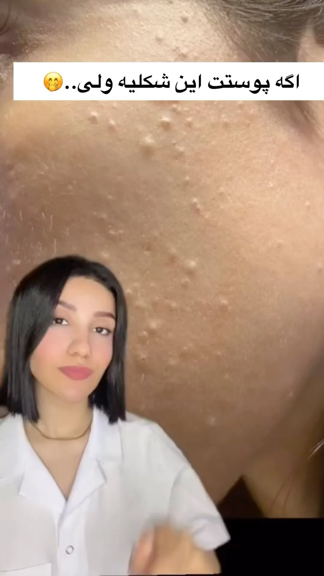 ژل ضدجوش دیفرین