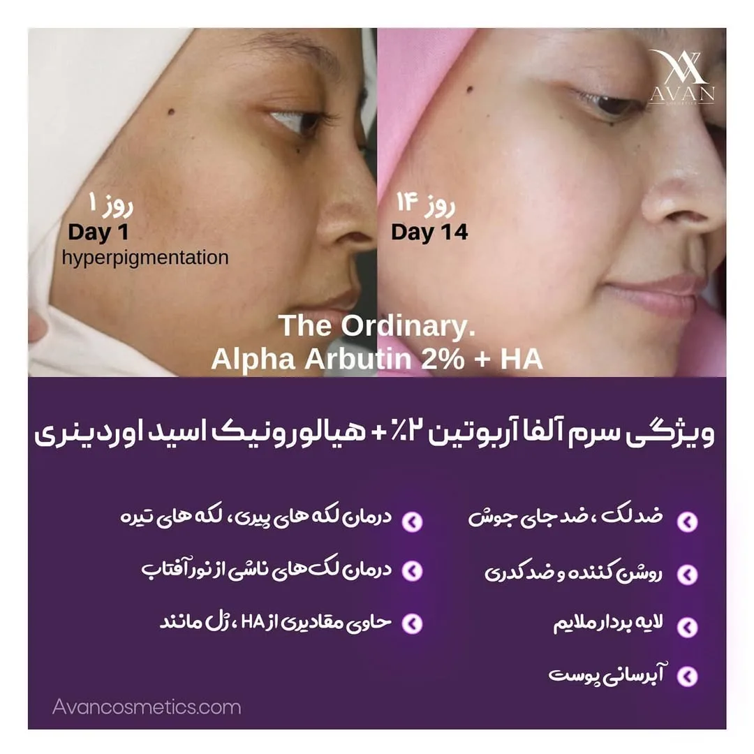 سرم آلفا آربوتین ضدلک — عکس ۴