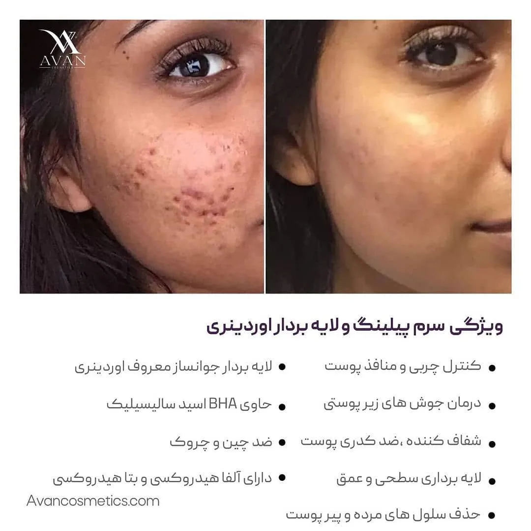 سرم لایه‌بردار پیلینگ AHA BHA — عکس ۶