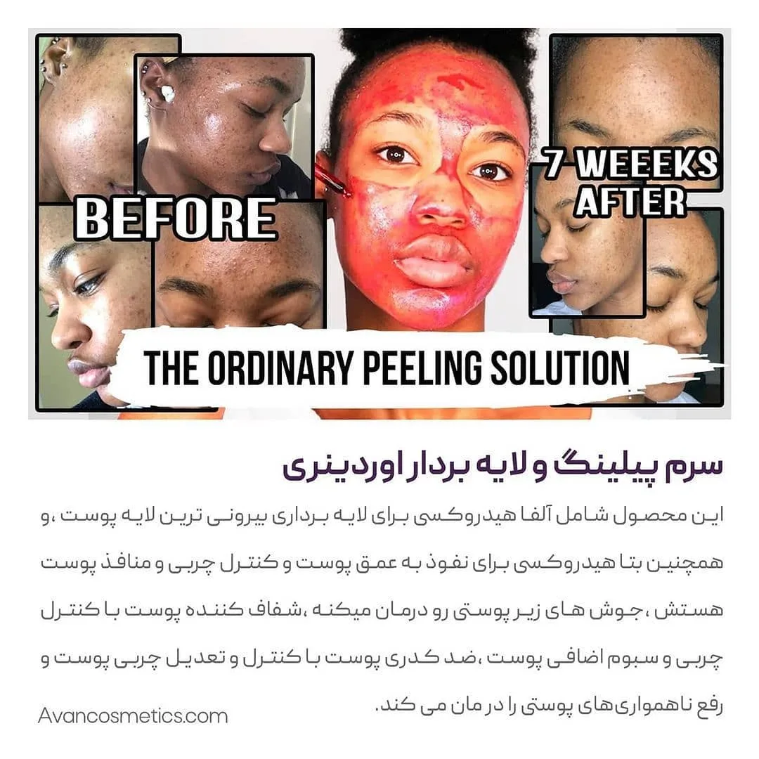 سرم لایه‌بردار پیلینگ AHA BHA — عکس ۷